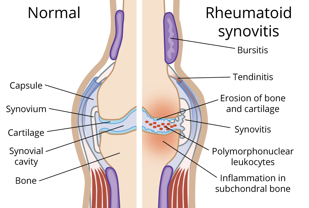 rheumatoid.png